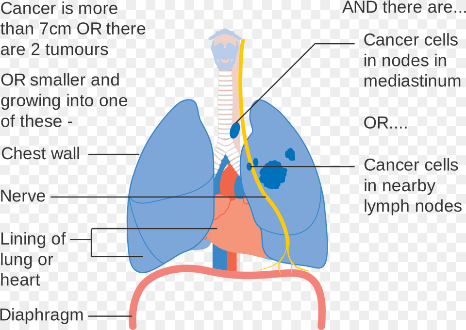 Clip Art Pictures Of Lung Cancer, Ct Scan Png