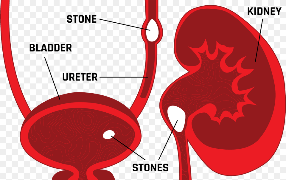 Clip Art Stones Overview Relief Illustration, Body Part, Stomach, Food, Ketchup Free Png Download