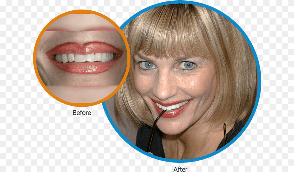 Close Up Before Of Diane S Mouth And Then An After Girl, Adult, Body Part, Female, Person Free Png