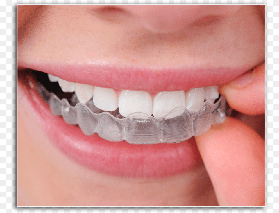 Closeup Of Patient Placing Invisalign Tray Invisalign Braces Cost In India, Body Part, Mouth, Person, Teeth Free Transparent Png