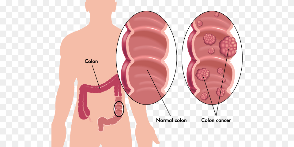 Colon Cancer Tumors Colon Cancer Vs Healthy Colon, Adult, Male, Man, Person Free Transparent Png