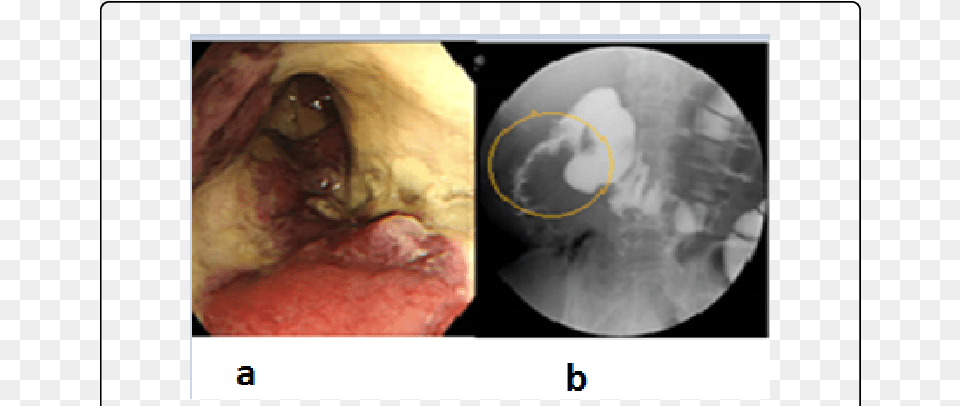 Colonoscopy Revealed A Circumferential White Coat And Medical Imaging, Ct Scan, Animal, Cat, Mammal Png