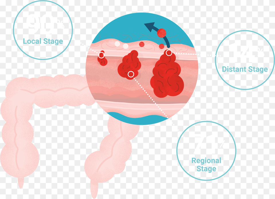 Colorectal Cancer Survival Rates Illustration, Face, Head, Person, Baby Free Png