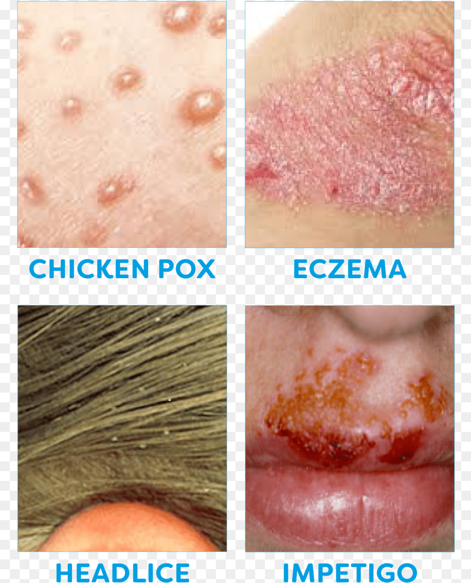 Common Childhood Illnesses 2 Meat, Face, Head, Person, Body Part Png