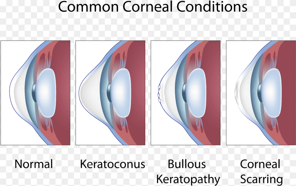 Common Corneal Conditions Keratoconus And Astigmatism, Art, Graphics, Lighting, Astronomy Png Image