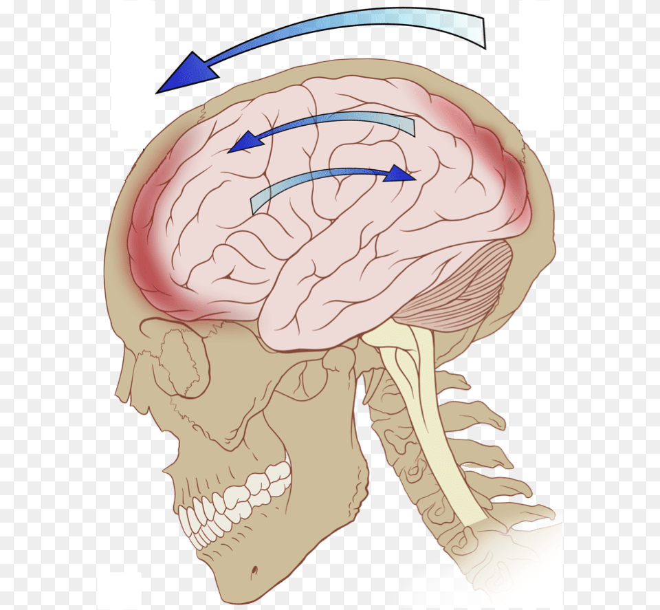 Concussion Whiplash Amp Migraine Related Injuries Primary Brain Injury, Body Part, Face, Head, Neck Free Png Download