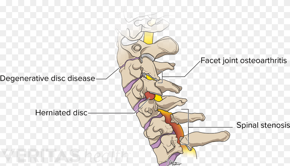 Conditions That May Occur In The Cervical Spine Cervical Vertebrae, Baby, Person Free Png