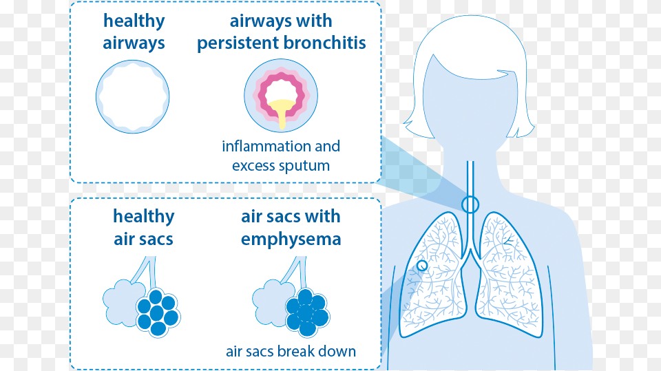 Copd Bronchitis Emphysema Graphic Finding The Missing Millions Copd, Text, Adult, Female, Person Png Image