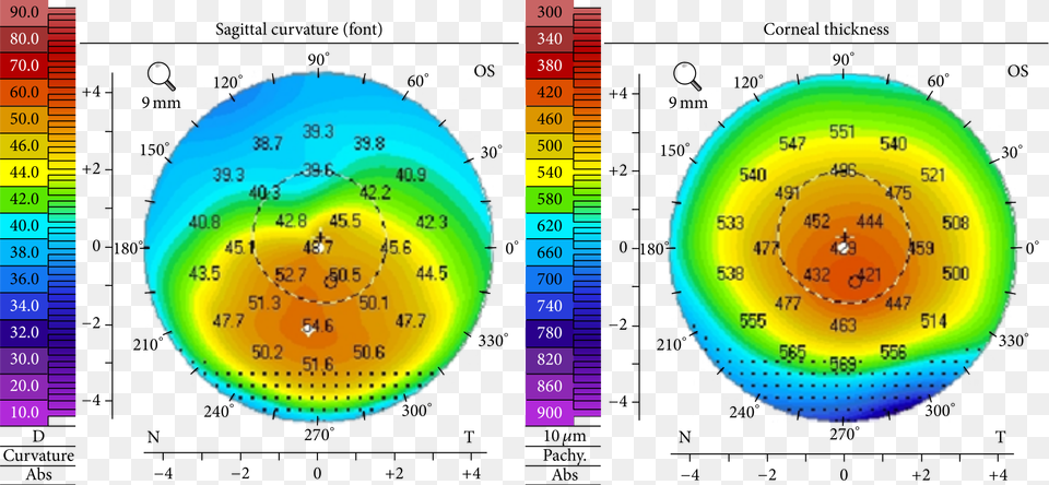 Corneal Topography Keratoconus, Sphere, Disk Png