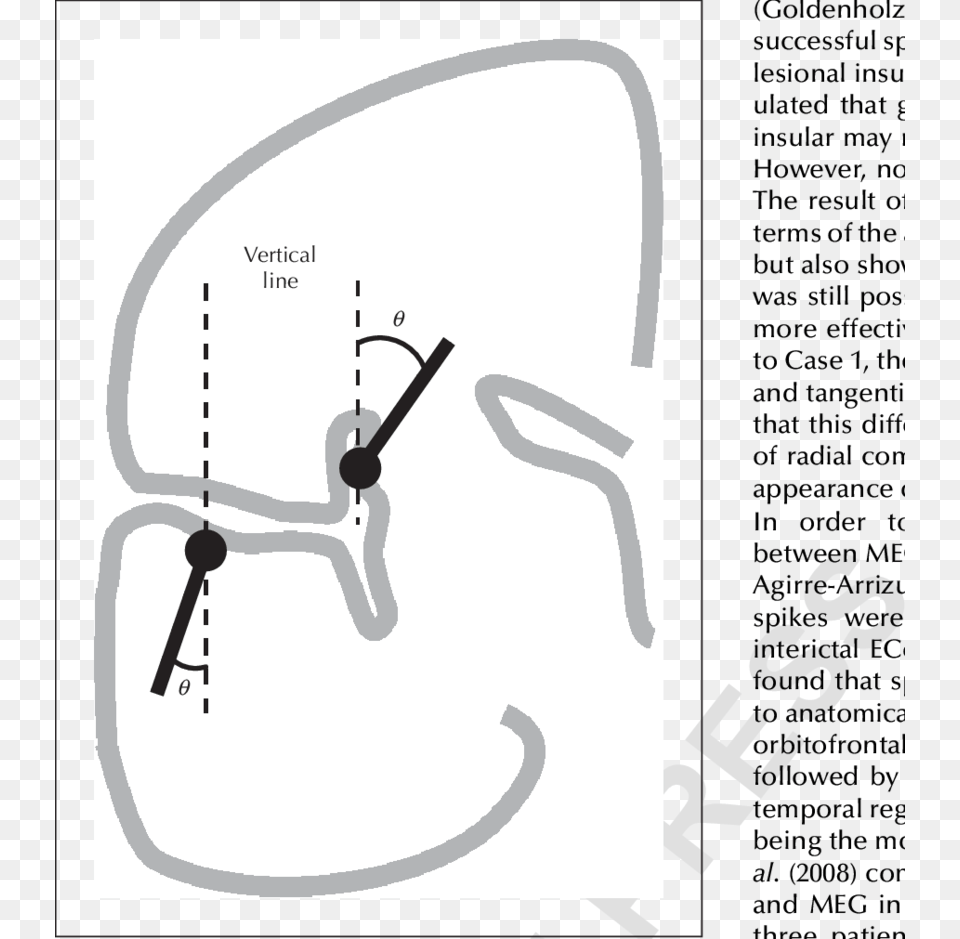 Coronal Schema Showing Angle Between The Spike Dipole Paper, Person, Smoke Pipe, Ct Scan Png