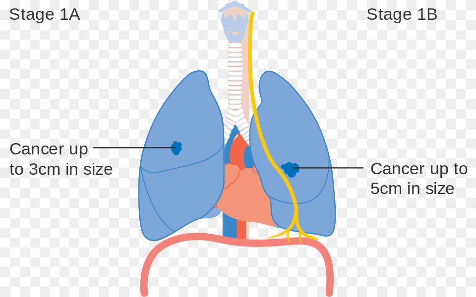 Cough Clipart Lung Cancer, Person Free Transparent Png
