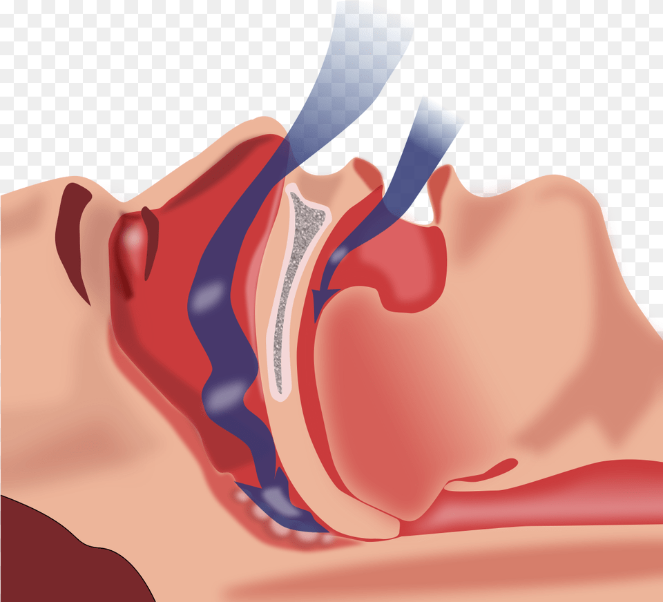 Cpap Treatment For Obstructive Sleep Apnea, Body Part, Face, Head, Neck Png Image