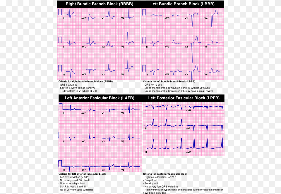 Criteria For Lbbb Rbbb Lafb Lpfb 42nd Street Photo, Text Png