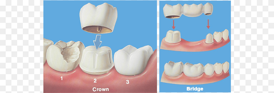 Crown Bridge Hobe Sound Dentist Dental Crown And Bridge, Teeth, Body Part, Person, Mouth Free Transparent Png