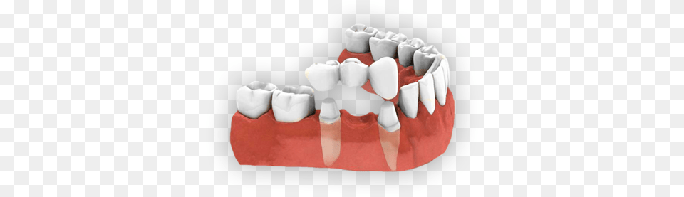 Crowns And Bridges Dental Bridge, Birthday Cake, Person, Mouth, Food Png Image