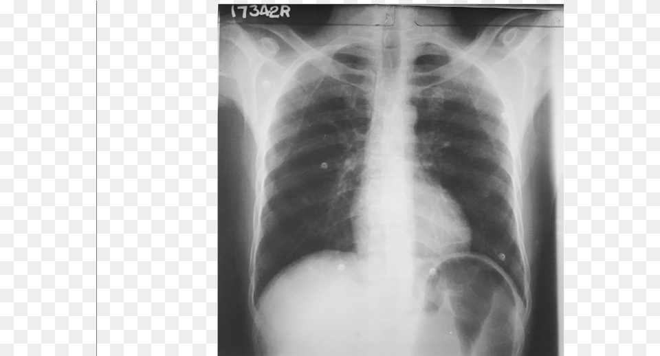 Cxr Pa Showing Distended Stomach Stomach Cxr, Adult, Bride, Female, Person Free Transparent Png
