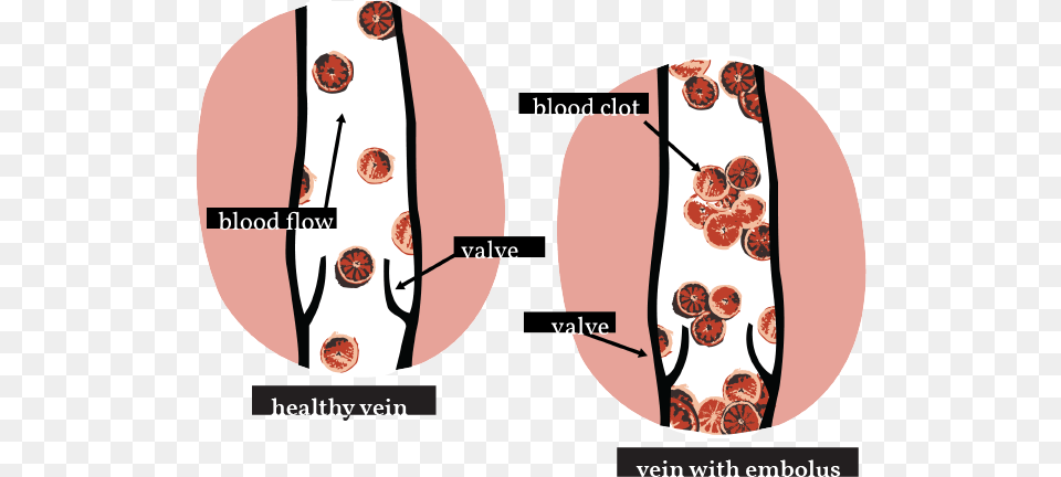 Deep Vein Thrombosis U2014 Womanly Magazine Circle Free Transparent Png