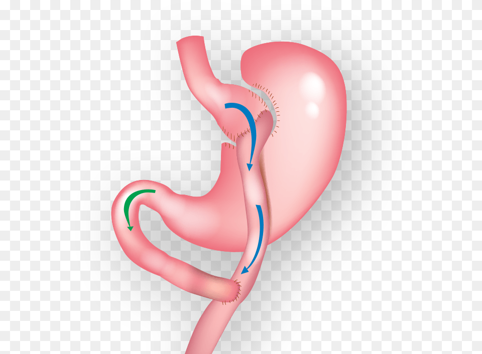 Demonstration Of Gastric Bypass Surgery Gastric Bypass, Body Part, Stomach, Heart, Adult Png Image