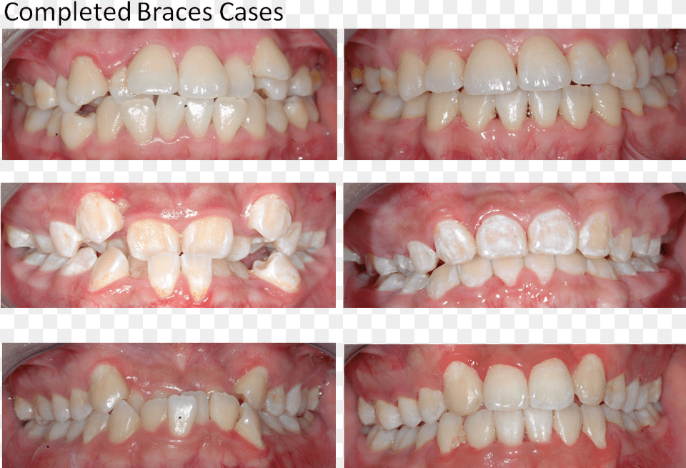 Dental Braces, Body Part, Mouth, Person, Teeth Free Png