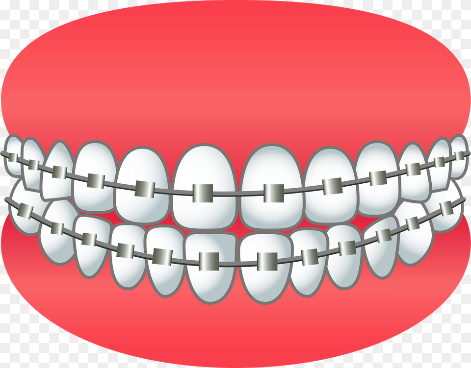 Dental Braces Clipart, Body Part, Mouth, Person, Teeth Free Png