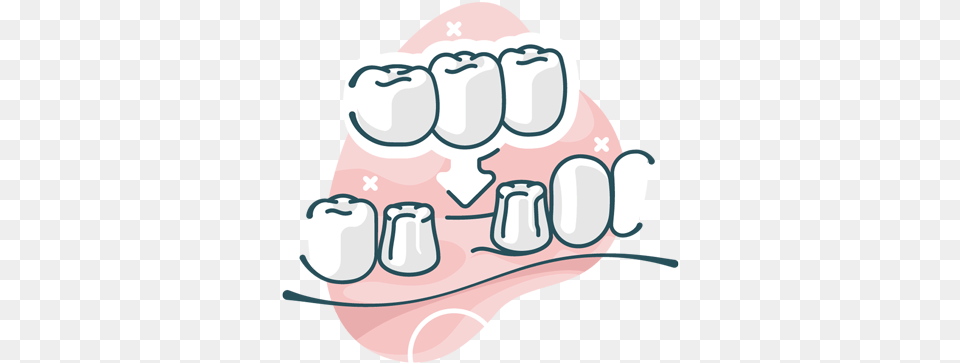 Dental Bridges Fist, Body Part, Mouth, Person, Teeth Png