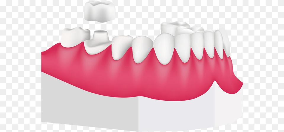 Dental Crowns At Toothbeary, Body Part, Mouth, Person, Teeth Png