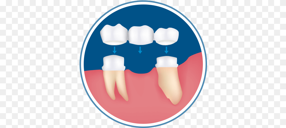 Dental Crowns Bridges In San Antonio Vertical, Body Part, Mouth, Person, Teeth Free Transparent Png