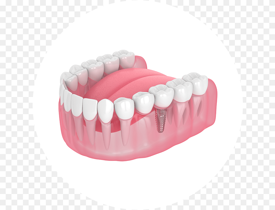 Dental Implant, Teeth, Body Part, Person, Mouth Png Image