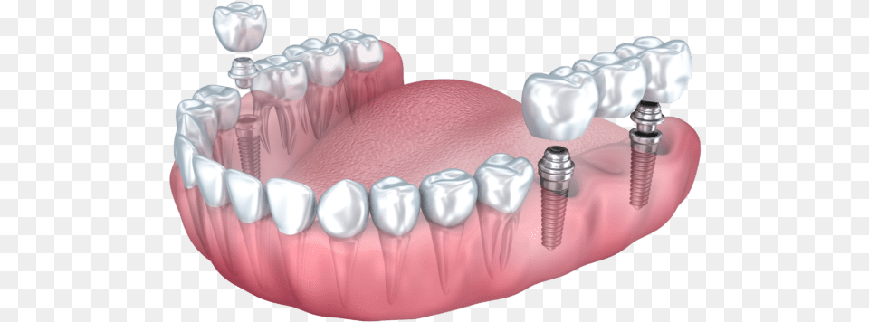 Dental Implant Benefits Summit Nj Multiple Dental Implants, Teeth, Body Part, Person, Mouth Free Png
