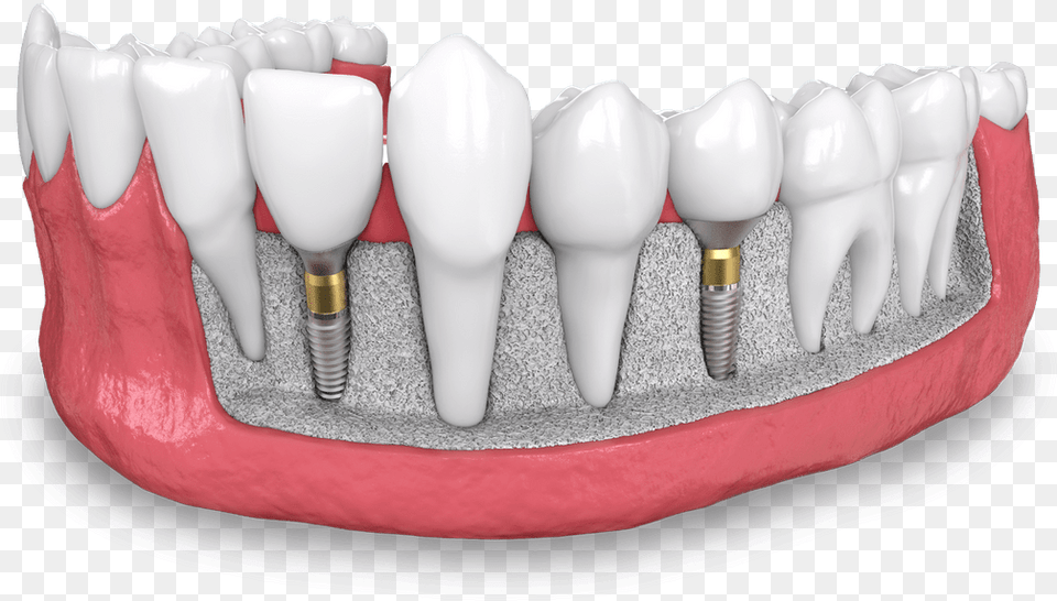 Dental Implant Model Dana Point Ca Dental Implant, Body Part, Mouth, Person, Teeth Png Image