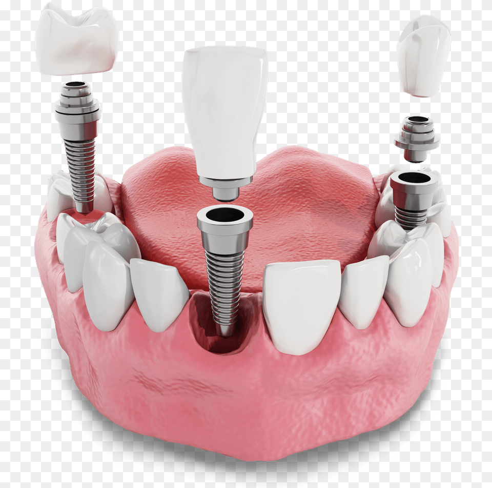Dental Implant Model Kansas City Mo Implant Dentar Pret, Body Part, Mouth, Person, Teeth Png Image