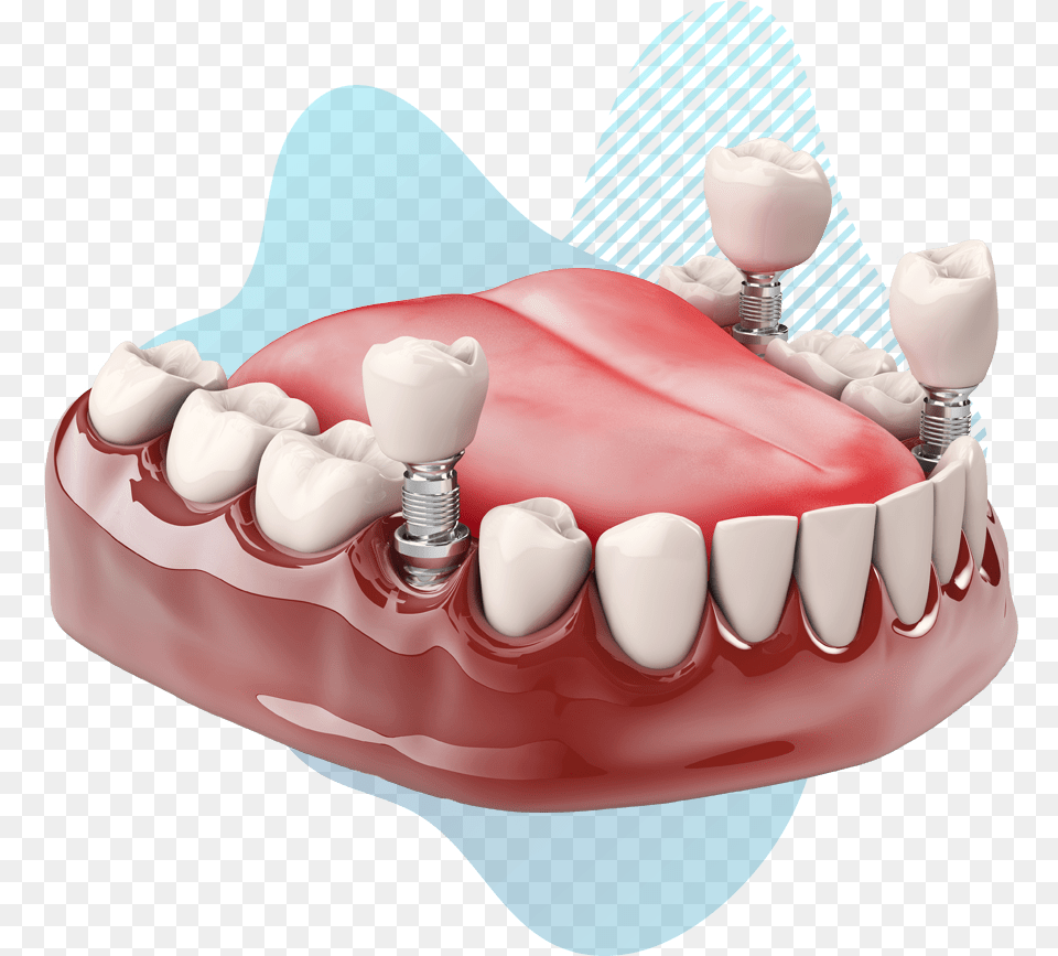 Dental Implant Model Pasang Gigi Palsu Geraham, Teeth, Body Part, Person, Mouth Png