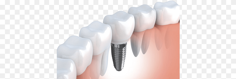 Dental Implants 1 Implante De Muelas, Teeth, Person, Body Part, Mouth Free Png Download