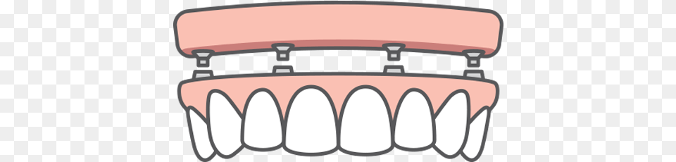 Dental Implants Grille, Body Part, Mouth, Person, Teeth Png Image
