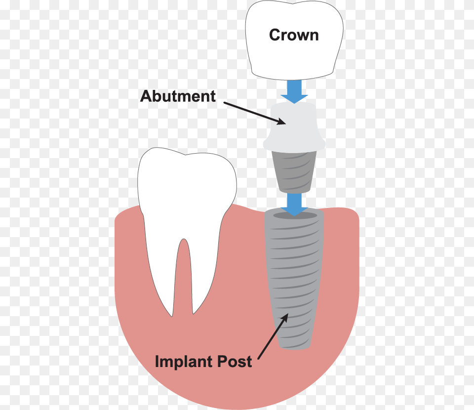 Dental Implants Illustration Dental Implant, Body Part, Mouth, Person, Teeth Free Transparent Png