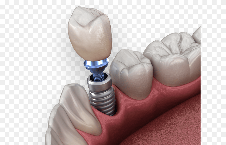 Dental Implants Implant Dental, Body Part, Mouth, Person, Teeth Free Transparent Png