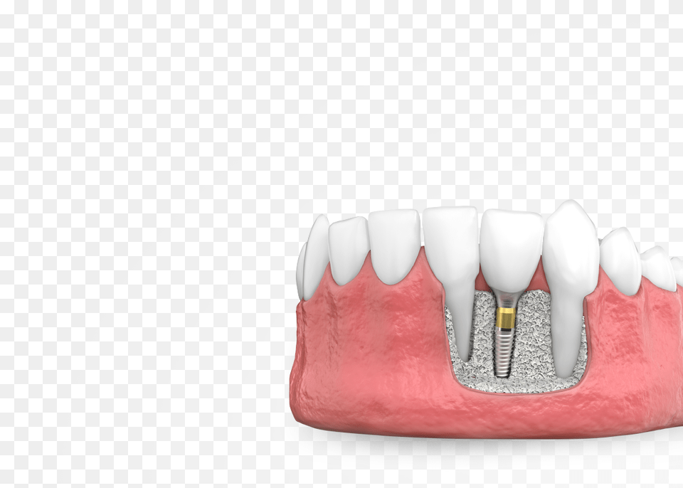 Dental Implants Marking Tools, Body Part, Mouth, Person, Teeth Png