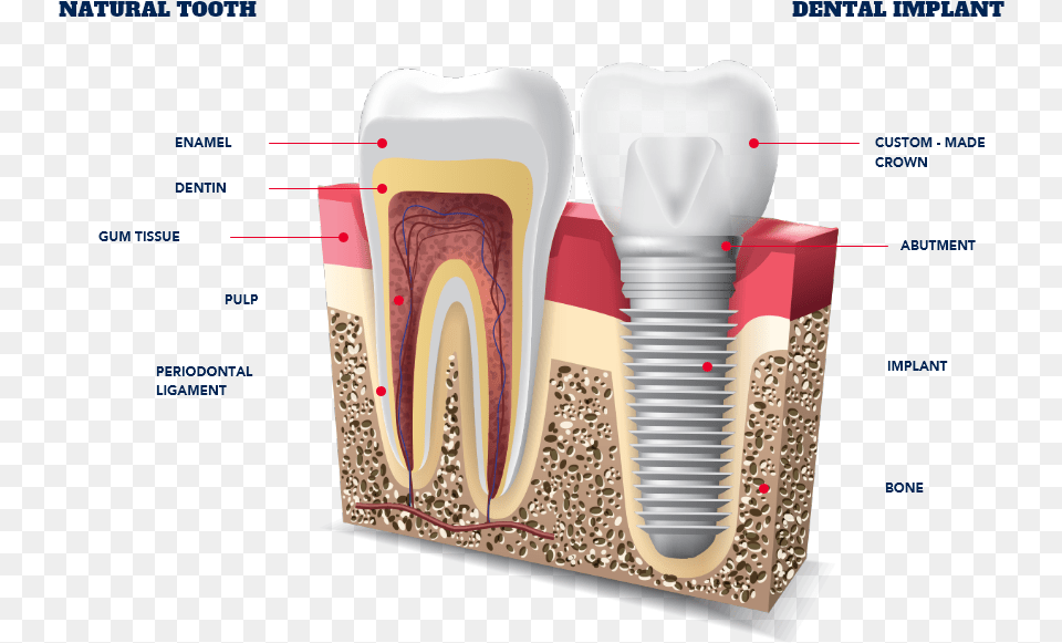 Dental Implants Types Getting New Teeth All Dental Implants In Jawbone, Ct Scan, Body Part, Face, Head Png