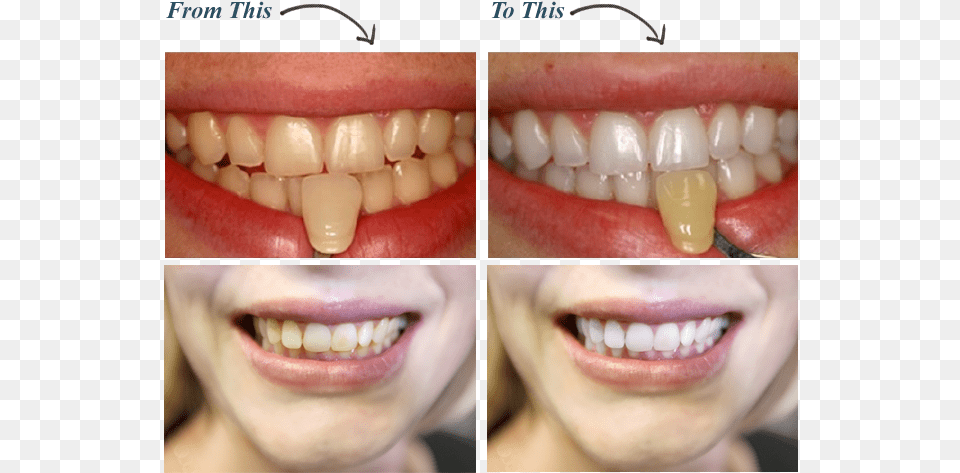 Dentistrytooth Bodypersonal Carelaughdentistry Can I Get My Teeth White, Body Part, Mouth, Person, Medication Png Image