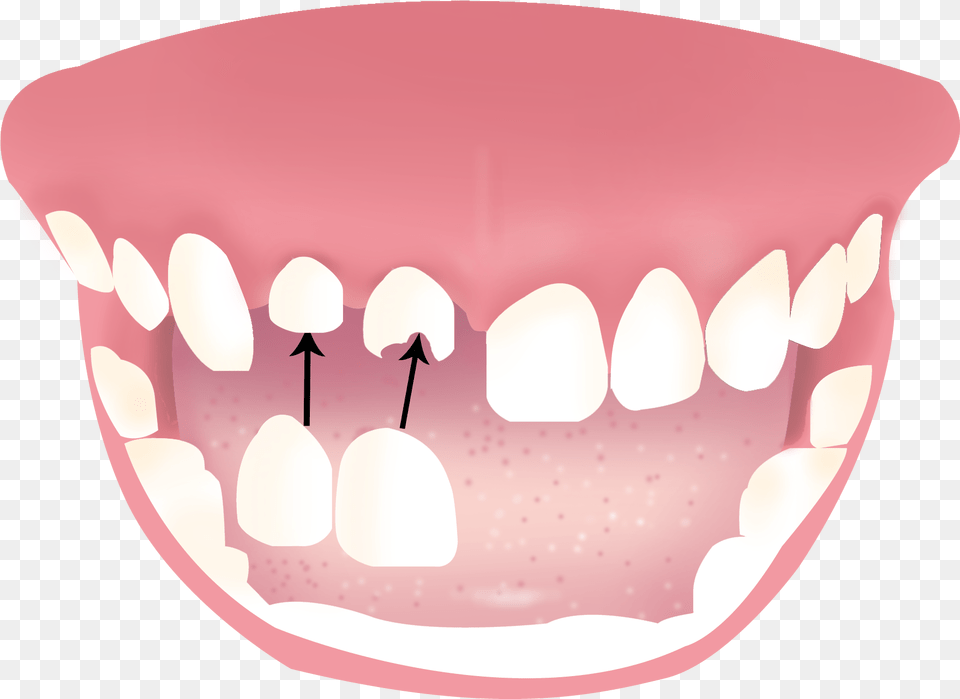 Dentures, Body Part, Mouth, Person, Teeth Png