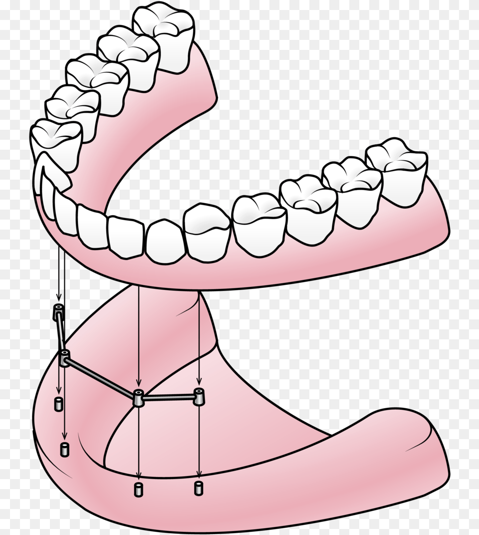 Dentures Valley Dental Components Of A Denture, Body Part, Mouth, Person, Teeth Png