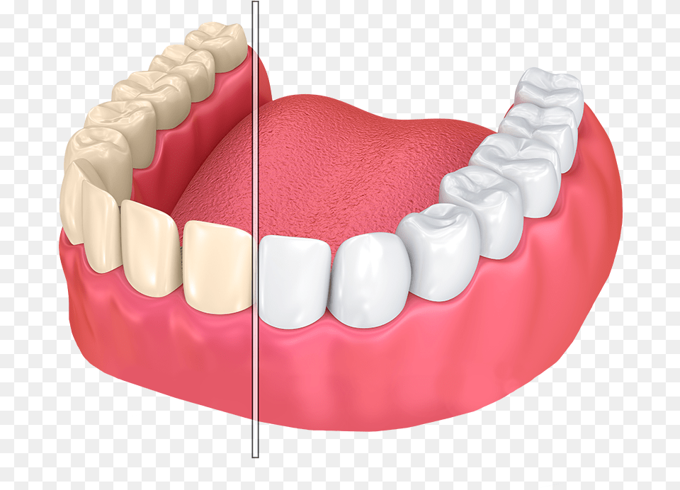 Dentures Whitening Teeth, Birthday Cake, Person, Mouth, Food Png Image