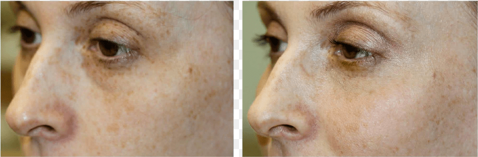 Dermal Filler Freckle, Face, Head, Person, Adult Png Image