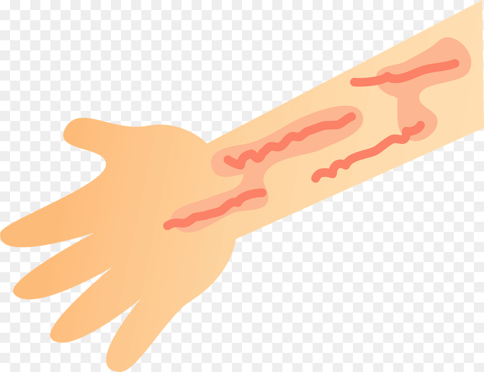 Dermatitis Skin Rash On The Arm Clipart, Wrist, Person, Hand, Body Part Png