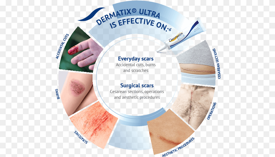 Dermatix Ultra Asia Before And After Dermatix Ultra, Body Part, Hand, Person, Adult Png Image