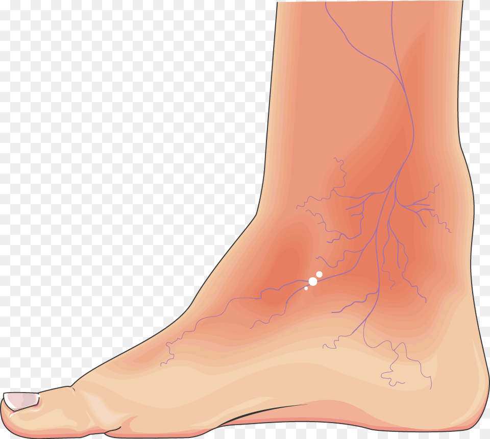 Diabatic Foot, Ankle, Body Part, Person, Skin Free Transparent Png