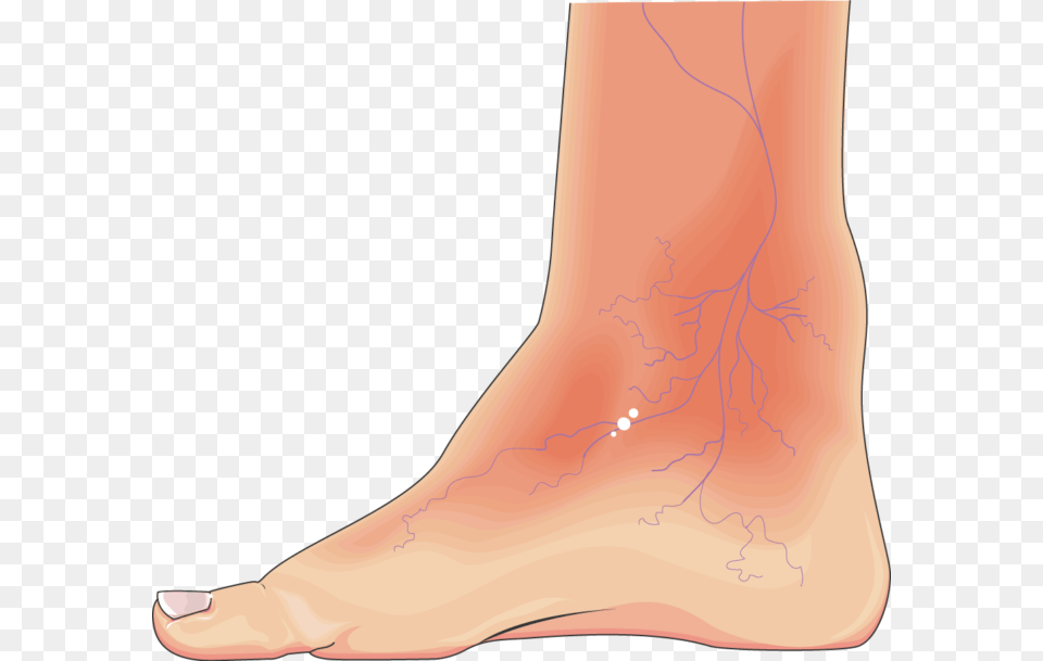 Diabetic Foot, Ankle, Body Part, Person, Skin Free Png