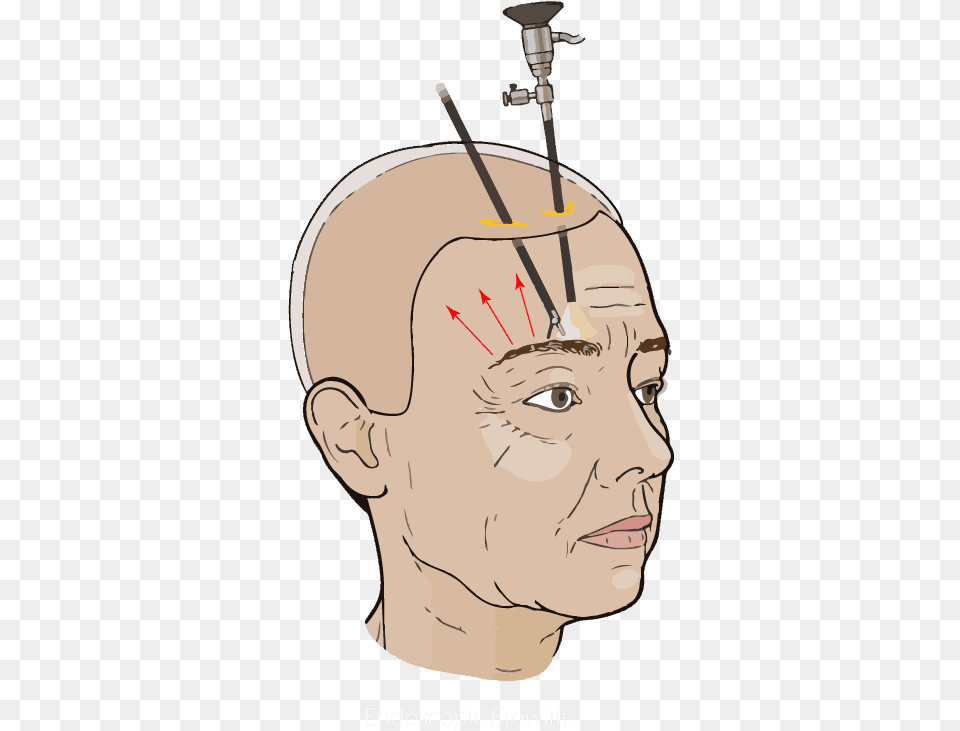 Diagram Of Endoscopic Brow Lift To Raise The Forehead Illustration, Face, Head, Person Free Transparent Png