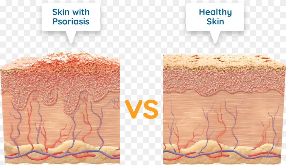 Diagram Of Skin With Psoriasis Vs Healthy Skin Psoriasis Dead Skin Cell Png Image