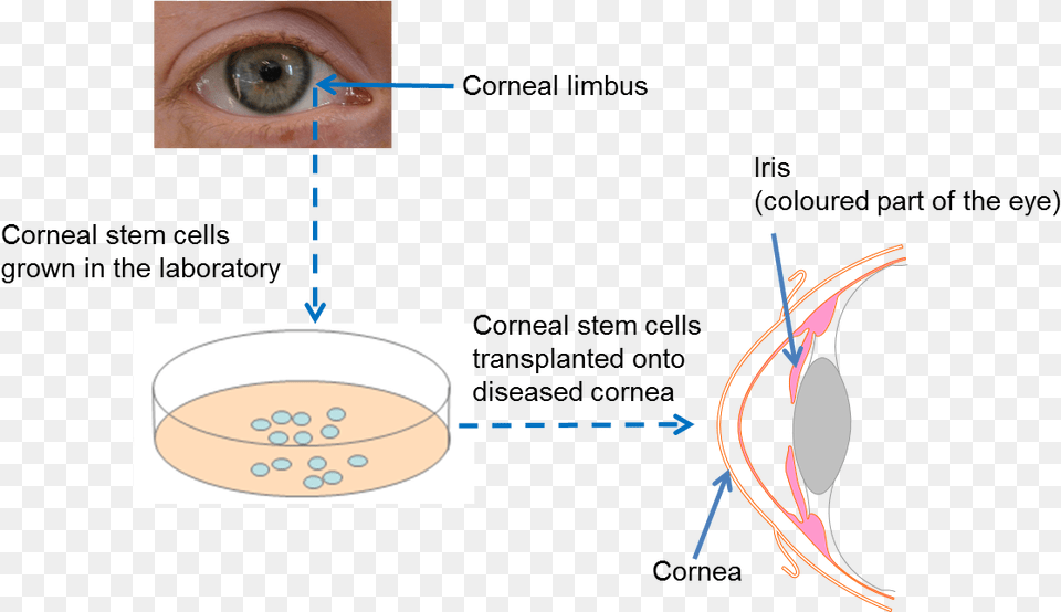 Diagram On Repairing The Cornea Holoclar Stem Cell, Face, Head, Person, Baby Free Png Download